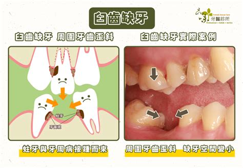 拔掉的牙齒|臼齒拔掉怎麼辦？五分鐘搞懂拔牙原因、流程、術後保。